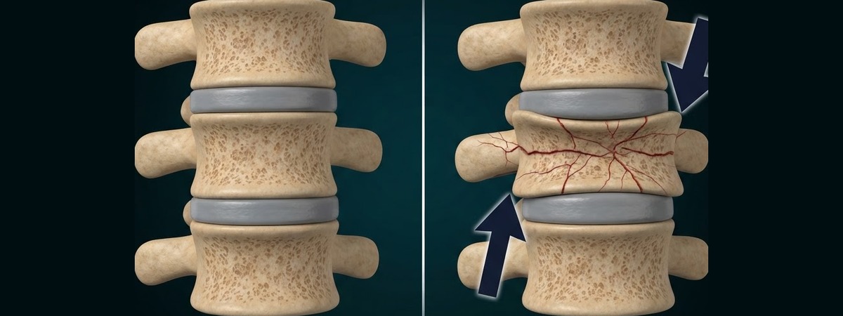 Side-by-side 3D illustration of a healthy vertebra and a compression-fractured vertebra